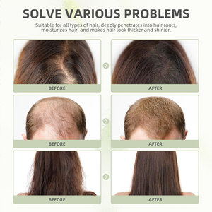 Cápsulas nutritivas de aceite de ricino negro natural para el crecimiento del cabello <span class=keywords><strong>EELHOE</strong></span> 30 piezas - Product Image 2