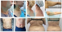 Lipolaser 1470nm pour œdème malar, laser pour poches sous les yeux, laser diode, machine de liposuccion corporelle