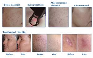 เครื่องเลเซอร์เศษส่วน Co2สำหรับกำจัดริ้วรอยบนผิวกระ Co2เลเซอร์เศษส่วน - Product Image 6