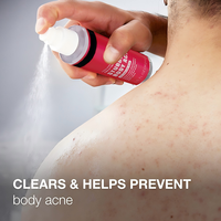 Spray anti-acné en vente chaude pour réduire les rougeurs, les gonflements et inhiber les bactéries, contrôle de l'acné du dos