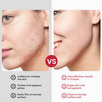 Crème anti-taches et cicatrices d'acné à prix bas, personnalisable, réparation rapide et efficace, lisse la peau, réduit les pores, acné