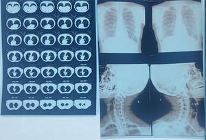 プレミアムインクジェット医療Tpuフィルムペットバッキング付きホワイト/ブルー医療フィルムロール富士フイルム医療フィルム - Product Image 6