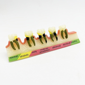 Medische Wetenschap Dummy Parodontitis Classificatie Tandheelkundig Model Voor Medische Schoolopleiding - Product Image 4