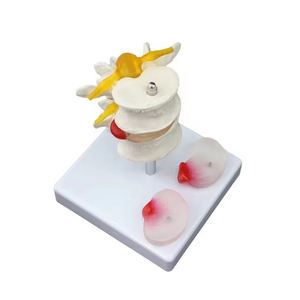 Modello di patologia della colonna lombare FRT038 Herniat disk modello patologico della Vertebra lombare umana - Product Image 1
