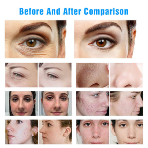 Máquina de Microdermoabrasión 10 en 1 Multifuncional de Hidro-Oxígeno para Limpieza Facial Profunda, Antienvejecimiento y Eliminación de Arrugas - Product Image 6