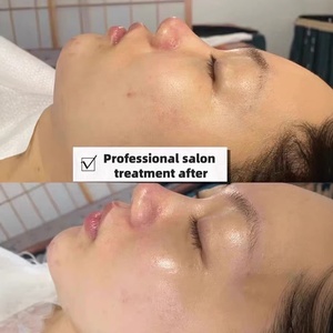 Solución Exfoliante Facial de Seis Ácidos y Tres Enzimas, <span class=keywords><strong>Peeling</strong></span> Químico, Minimizador de Poros, Tratamiento Profesional de Salón - Product Image 4