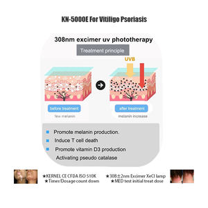 Appareil de luminothérapie excimère KN-5000E 308 nm |   Pèse seulement 1 kg, comme une bouteille d'eau |   Traite le vitiligo en 3 mois - Product Image 5