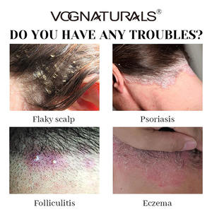 Shampooing antifongique pour le <span class=keywords><strong>psoriasis</strong></span> du <span class=keywords><strong>cuir</strong></span> <span class=keywords><strong>chevelu</strong></span> de marque privée shampooing pour la folliculite à l'acide salicylique shampooing pour la dermatite séborrhéique à l'huile d'arbre à thé - Product Image 5