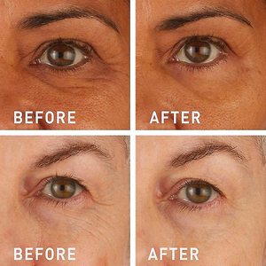 Patchs Microneedle au rétinol de marque privée pour le <span class=keywords><strong>front</strong></span>, la zone des yeux, anti-rides, ligne de sourire, acide hyaluronique invisible - Product Image 5