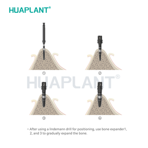 Accessoire manuel d'expansion osseuse Huaplant en acier inoxydable, manipulation d'expansion osseuse, classe I, compatible avec tous les implants de marque - Product Image 5