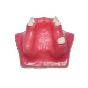 Modèle de communication médecin-patient pour l'implantation dentaire, aide pédagogique orale de classe I pour le lifting du sinus maxillaire, dents manquantes - Product Image 1