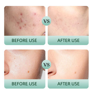 Tea Tree Skin Care <span class=keywords><strong>Kit</strong></span> 4 Productos con control <span class=keywords><strong>de</strong></span> aceite <span class=keywords><strong>de</strong></span> ácido salicílico Anti Acné <span class=keywords><strong>Facial</strong></span> Set para <span class=keywords><strong>piel</strong></span> <span class=keywords><strong>grasa</strong></span> - Product Image 5