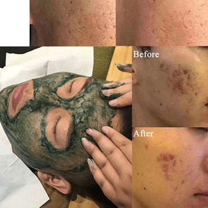 Peeling de algas blanqueamiento Melasma Peel Kit algas naturales hueso planta extracto máscara rejuvenecimiento hidratar cuidado de la piel Facial - Product Image 6