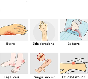 भविष्य चिकित्सा उन्नत कैल्शियम Alginate फाइबर घाव ड्रेसिंग चिकित्सा आपूर्ति