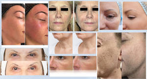 Korea <strong>Aesthetic</strong> Meso Gun Skin Firming Multi Needles 9 Pins / 5 Pins Hyaluronic Acid <strong>Injection</strong> for Face - Product Image 6