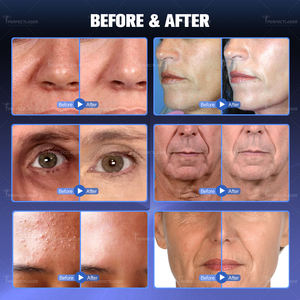 מכשיר יופי הידרה 10 ב-1 רב תכליתי לסלון יופי, ניקוי עמוק של הפנים, הצרת נקבוביות, ציוד מקצועי לטיפוח העור - Product Image 5