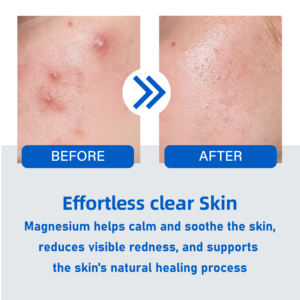 <span class=keywords><strong>2026</strong></span> सबसे ज्यादा बिकने वाले किनारे-दबाया मुँहासे पैच अल्ट्रा-पतले किनारे अदृश्य पिम्पल कवर - Product Image 6