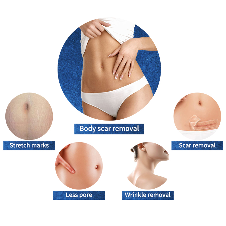 Fractional Microneedling RF Radio Frequency Microneedling Microneedle Radiofrequency Micro Needle Fractional Rf