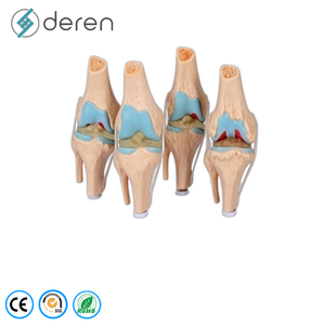 Ensemble de 4 modèles pathologiques de l'articulation du genou, modèle d'anatomie du genou en stade d'<span class=keywords><strong>arthrose</strong></span> pour l'enseignement médical - Product Image 3