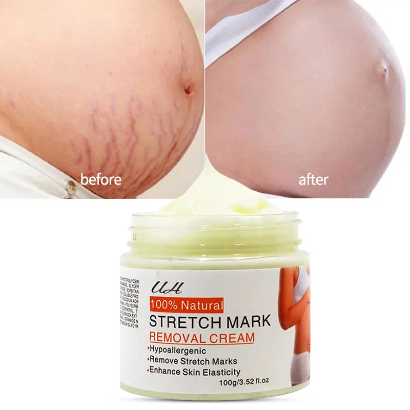 Stretch Mark Preventie Crème Litteken En Striae Remover Crème Hypoallergeen En Parabenen-Gratis Striae Crème