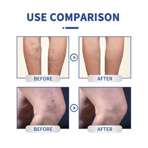 Crème Végétale pour <span class=keywords><strong>Varices</strong></span> Écologique Personnalisable pour le Soulagement des Douleurs Corporelles et le <span class=keywords><strong>Traitement</strong></span> des Vascularites - Product Image 6