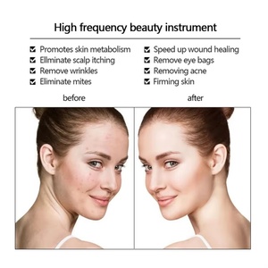 Máquina Profesional Portátil de Terapia de la Piel, Varita de Alta Frecuencia para Tratamiento del Acné, Lifting Facial, Específica para el Cuidado de la Piel del Rostro - Product Image 5