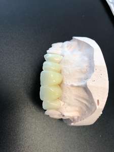 Denti Artificiali <span class=keywords><strong>in</strong></span> Resina Personalizzati con Alimentazione Elettrica per Tutti dai Laboratori Dentali Cinesi - Product Image 5