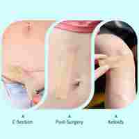 Bandes de silicone de qualité médicale, imperméables, stériles EO, certifiées CE, réutilisables pour cicatrices chirurgicales, chéloïdes, acné et brûlures