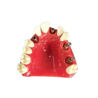 Modelo de implante dental: modelo de entrenamiento dental de alta fidelidad para educación y práctica de Implantología