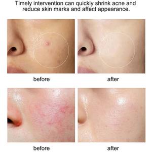 เซรั่มบำรุงผิว<span class=keywords><strong>หน้า</strong></span>อะโลเวร่าขั้นสูง: <span class=keywords><strong>รักษา</strong></span><span class=keywords><strong>สิว</strong></span>และริ้วรอย ช่วยกระตุ้นการไหลเวียนของน้ำในรูขุมขน ปรับสีผิวให้สม่ำเสมอ ปราศจากน้ำมัน สูตรต่อต้านริ้วรอยและเพิ่มความกระจ่างใส - Product Image 6