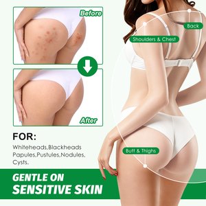 Crema Corporal Herbal Barata para el Acné en Glúteos y Muslos, Calmante, Elimina Granos, Suaviza, Repara la Piel, Anti-Acné - Product Image 6