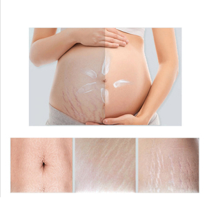 Crème <span class=keywords><strong>anti</strong></span>-vergetures pour le corps, prix direct usine, vente flash - Product Image 5