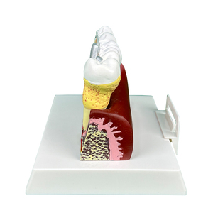 Mô hình giảng dạy y học nha khoa tính toán nha khoa, sâu răng, sâu răng, hoại tử, mở rộng 4 lần mô hình bệnh lý toàn diện của răng - Product Image 5