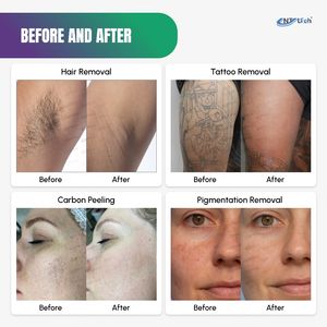 Professionale 4 in 1 diodo Laser depilazione Laser al carbonio Peel tatuaggio rimozione macchina - Product Image 5