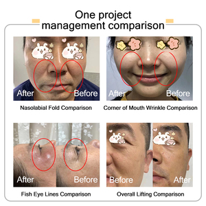 Máquina Profesional de Alta Intensidad para Lifting Facial |   Dispositivo de Belleza de 5 Cartuchos para Reafirmar la Piel y Antiarrugas - Product Image 3