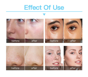 Synthétiseur multifonctionnel de traitement de beauté Aqua Jet Peel pour la gestion de la peau et le rajeunissement de la peau <span class=keywords><strong>ADDY</strong></span> - Product Image 4