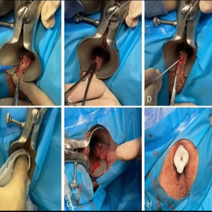 Terbaru wasir <span class=keywords><strong>Laser</strong></span> dioda Device tumpukan wasir <span class=keywords><strong>Laser</strong></span> bedah perangkat perawatan - Product Image 6