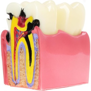 Modelo Educativo de Caries Dentales, Ampliado 6 Veces en Sección Transversal, Material de Resina para Educación Anatómica y Enseñanza de Salud Dental - Product Image 2