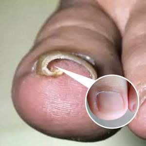 Soins des pieds Meilleurs remèdes contre les infections Traitement liquide des champignons des orteils Réparation fongique des ongles - Product Image 3