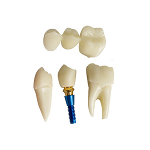 Modèle anatomique <span class=keywords><strong>dentaire</strong></span> 4x pour la démonstration des implants, la restauration de prothèses, la ponte <span class=keywords><strong>dentaire</strong></span> détachable, la <span class=keywords><strong>couronne</strong></span> et l'utilisation pédagogique - Product Image 2