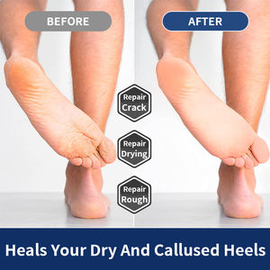 Idratante personalizzato e idratante Anti fungine e Cracking <span class=keywords><strong>piedi</strong></span> 40% Urea plantare a secco <span class=keywords><strong>per</strong></span> <span class=keywords><strong>piedi</strong></span> <span class=keywords><strong>per</strong></span> tacchi screpolati - Product Image 5