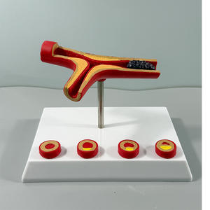 Modèle de blocage des vaisseaux sanguins en anatomie humaine LYA-002, concentration sanguine, <span class=keywords><strong>pathologie</strong></span> des graisses, atherosclérose, <span class=keywords><strong>pathologie</strong></span> <span class=keywords><strong>vasculaire</strong></span> - Product Image 1