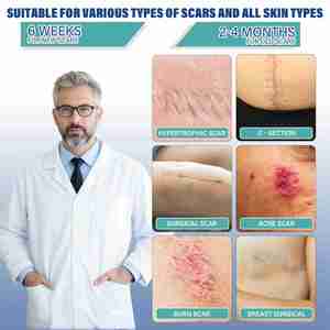 แผ่นซิลิโคนปิดแผลเป็น, เทปซิลิโคนปิดแผลเป็น (ขนาด 1.6 นิ้ว x 158 นิ้ว แบบม้วน - 4 เมตร), แผ่นซิลิโคนปิดแผลเป็นสำหรับแผลผ่าตัด, กำจัดเนื้อเยื่อคีลอยด์ - Product Image 3