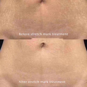 Mejor Crema para Eliminar Estrías, Eliminación Profunda de Estrías y <span class=keywords><strong>Cicatrices</strong></span>, Reparación Intensiva Permanente, Reafirmante de la Piel Corporal B - Product Image 6