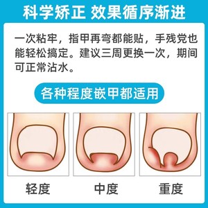 Cofoe – ensemble de patchs correcteurs pour ongles incarnés, avec adhésif et adoucissant, pour adultes, soins de pédicure - Product Image 3