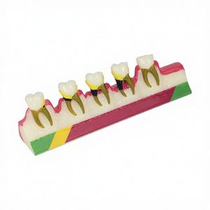 Modelo Anatómico de Periodoncia Oral para Gingivitis, Periodonitis Crónica, Clasificación de Grado, Comunicación Dental - Product Image 1