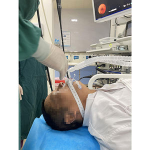 CE ISO NMPA disetujui Bronchoscope masker Laryngeal Airway Ultrasound terpandu Ebus masker Laryngeal masker medis - Product Image 3
