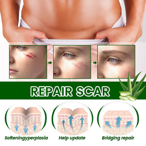 Crema Natural de <span class=keywords><strong>Aloe</strong></span> Vera <span class=keywords><strong>para</strong></span> Eliminar Estrías y Cicatrices, Suavizante, Reparadora de <span class=keywords><strong>Heridas</strong></span>, Cuidado Diario de la Piel - Product Image 4