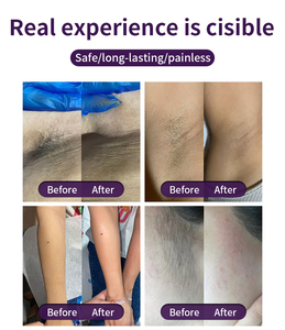 Macchina di epilazione del Laser a diodi 755NM 940NM 1064NM 808nm - Product Image 5