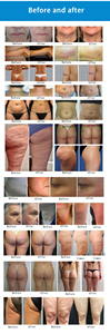 เครื่องนวดบำบัดแบบพกพาสำหรับฟื้นฟูผิว เครื่องนวดตัวแบบลูกกลิ้งด้านใน ลดน้ำหนัก - Product Image 4